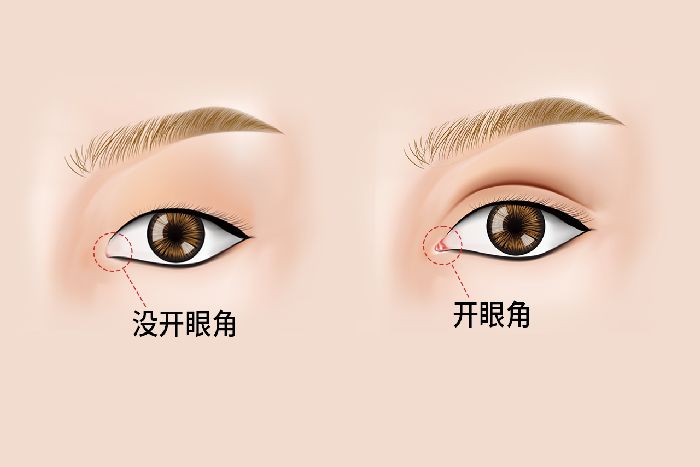 韩式微创开眼角需要伤口拆线吗？