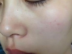 为什么激光可以祛斑?激光祛斑会留疤吗?