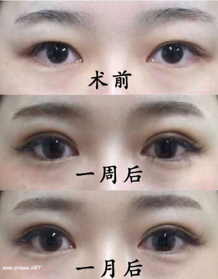 全切双眼皮：副作用与失败风险探讨
