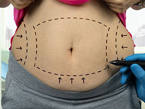 揭秘手术认知误区:吸脂抽的脂肪越多就会瘦的越快吗?