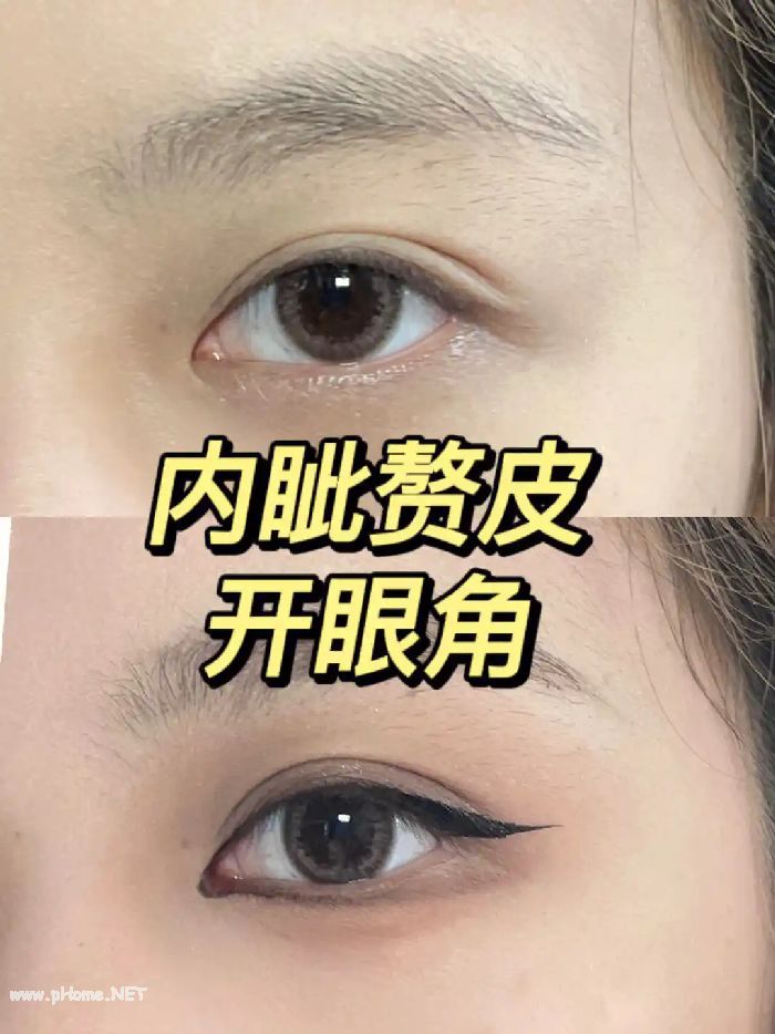 韩式微创开眼角需要伤口拆线吗？