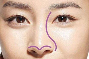 鼻尖塑形:定义与价格解析