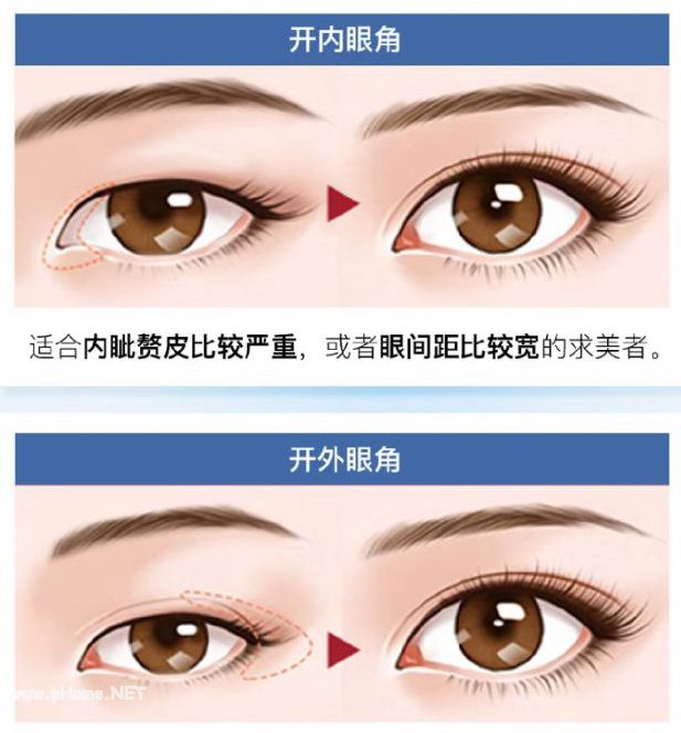 韩式微创开眼角需要伤口拆线吗？