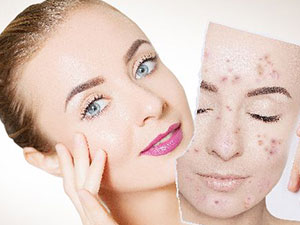 光子嫩肤:黄褐斑的克星及其多重美容效果