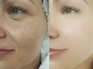 彩光祛斑与激光祛斑:区别与优势解析